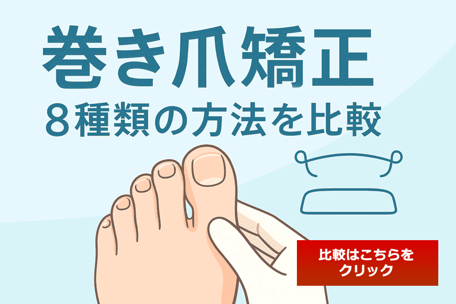 巻き爪矯正8種類